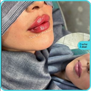 بهترین مرکز تزریق فیلر لب در تهران