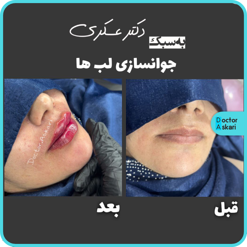بهترین مرکز تزریق فیلر لب در ایران