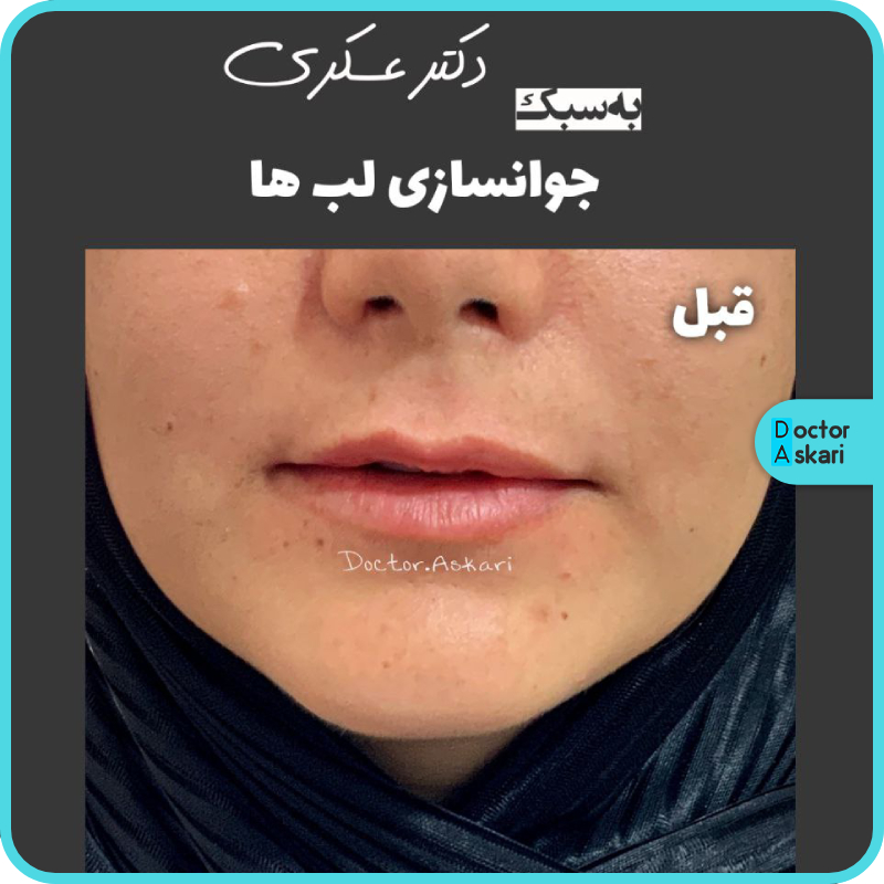 بهترین مرکز تزریق فیلر لب نچرال در ایران