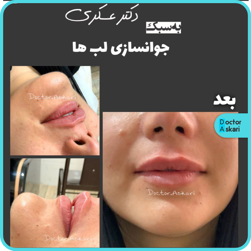 بهترین مرکز تزریق فیلر لب نچرال در ایران